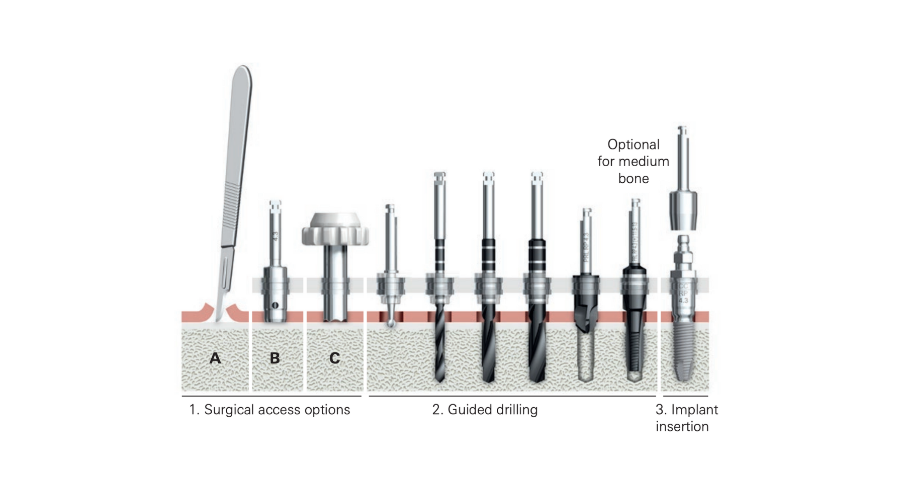 8 Surgical Guide Design Considerations for Nobel Parallel Conical Conn