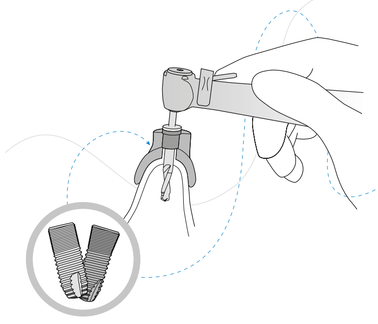 Astra Tech Implant System Manual